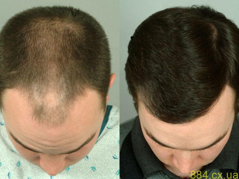 Особливі моменти пересадки волосся Особливі моменти пересадки волосся