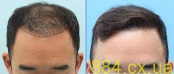 Больно ли пересаживать волосы? Больно ли пересаживать волосы?