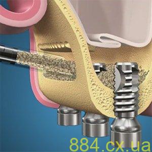 Цены на операцию синус лифт и что вам необходимо знать Цены на операцию синус лифт и что вам необходимо знать