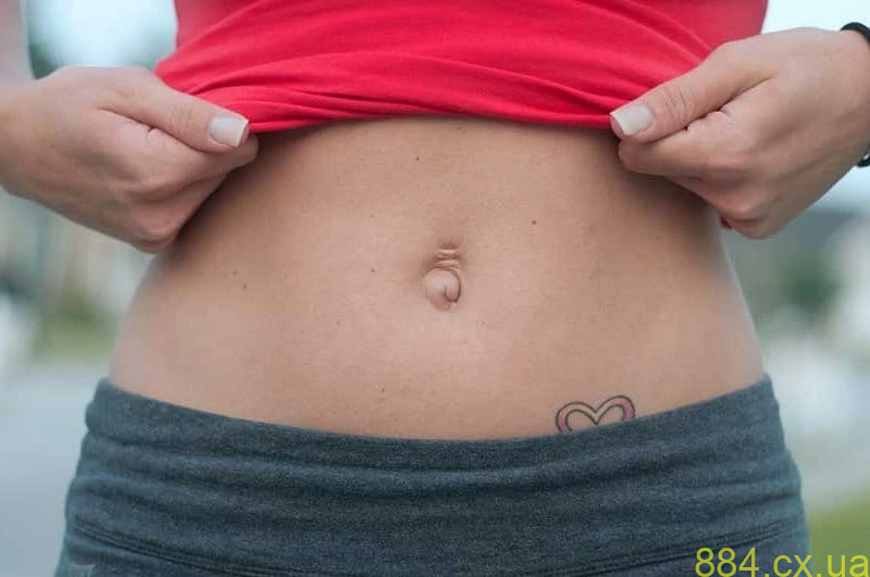 Пупкова грижа. Операція з видалення пупкової грижі лапароскопічним методом Пупкова грижа. Операція з видалення пупкової грижі лапароскопічним методом