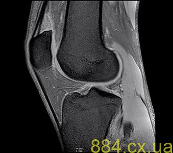 Диагностика коленей с помощью МРТ
